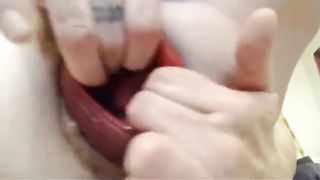 What a Prolapse and Gape